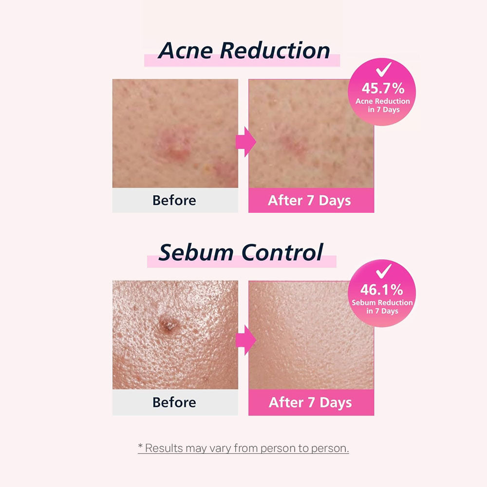 Easyderm Band Beauty Real Calming Pimple Patch - Ultra-Thin & Invisible for Seamless Adhesion | Niacinamide, Hyaluronic Acid, Panthenol, EGF | Transparent Micropoint, Acne Spot Care, K-beauton